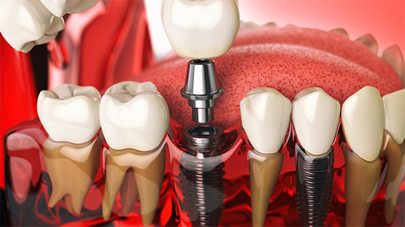 Dental-implant-in-turkey